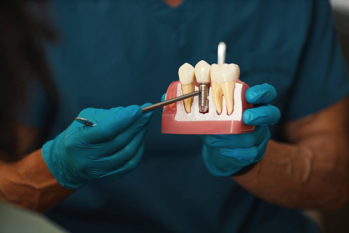 Are Dental Implants Worth It? Benefits That Go Beyond a Beautiful Smile
