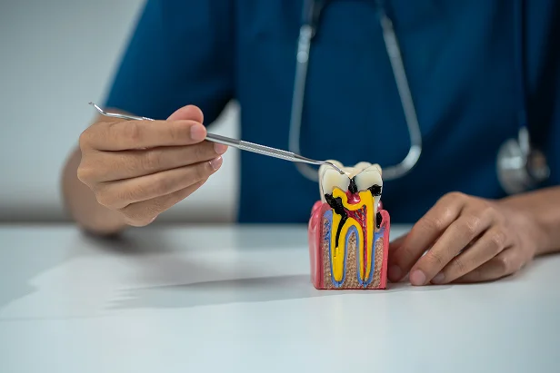 Dentist uses a metal tool to point at a colorful tooth model with visible decay. The background is a blurred person in a blue outfit, conveying a clinical setting.